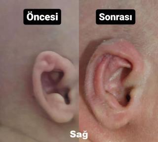 Bebeklerde Ameliyatsız Kepçe Kulak Tedavisi